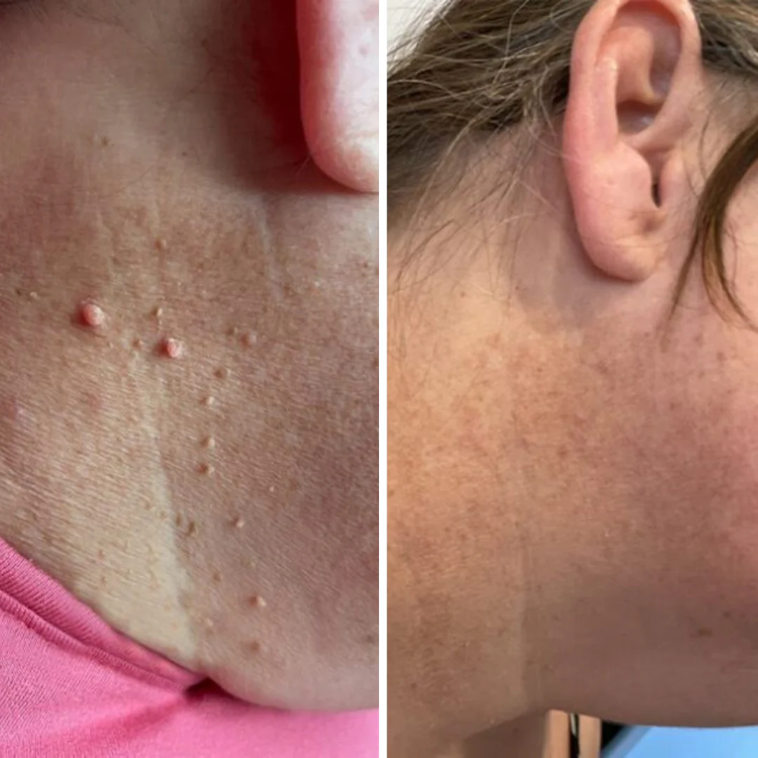 MedOff ™ - Et Beni Temizleme Kiti