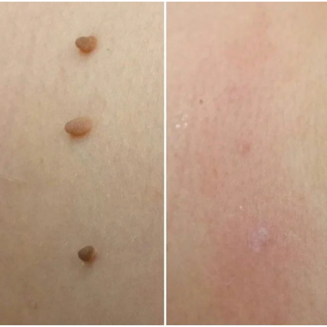 MedOff ™ - Et Beni Temizleme Kiti