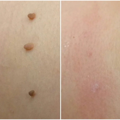 MedOff ™ - Et Beni Temizleme Kiti